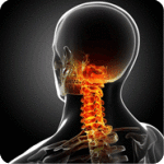 3d drawing of the cervical spine of a person with neck pain