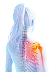 3-D transparent drawing of a woman with an inflamed scapula due to weak muscles and fibromyalgia