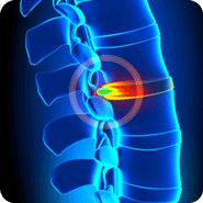 Disc Problems Drawing of spine with inflamed dis