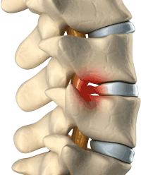 Diagram of lumbar spine with inflamed deranged disc